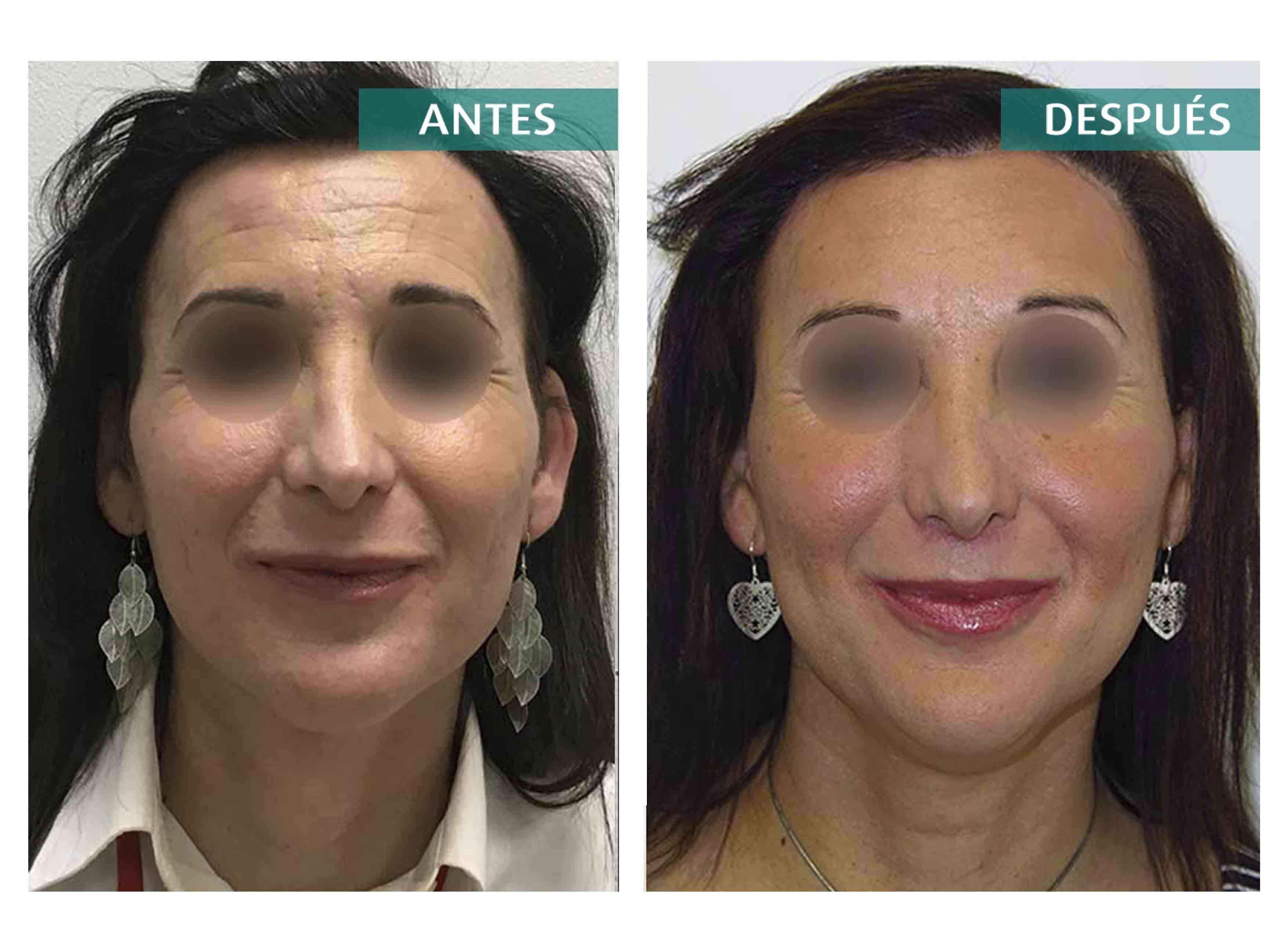 La feminización facial ayuda a las mujeres trans a reafirmar su identidad de género, según una revisión de estudios